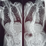 San Rafael: Una madre reclama por la demora en la operación de columna de su hijo y la falta de pago a prestadores de discapacidad