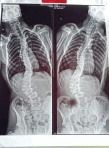 Belen-Luna-operacion-de-columna