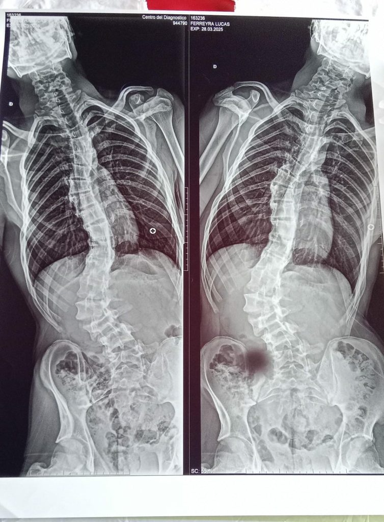 Belen-Luna-operacion-de-columna