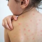 Se confirma un caso importado de sarampión. La paciente viajó a México recientemente