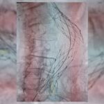 Primera recolocación exitosa de endoprótesis aórtica